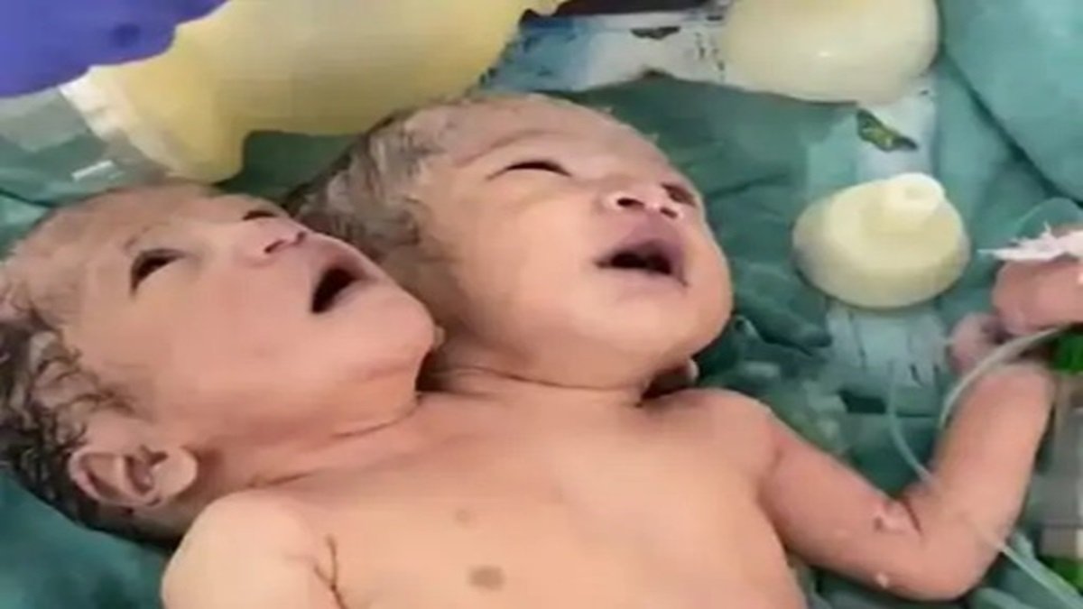 Indore Two Headed Girl : इंदौर में जन्मी दो सिर वाली बच्ची की हालत स्थिर, मां के दूध और वेंटिलेटर से मिल रही जिंदगी