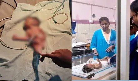 छत्तीसगढ़ में पैदा हुआ जलपरी जैसे पैरों वाला बच्चा, जन्म के 3 घंटे बाद मौत, डॉक्टरों ने कहा- दुनिया में अब तक सिर्फ 300 केस