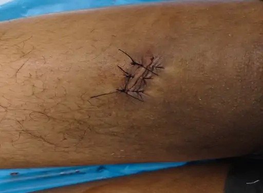 रायपुर में पुरानी रंजिश में युवक को मारा चाकू, पैर में लगे टाके, रायपुर पुलिस ने आरोपी को किया गिरफ्तार