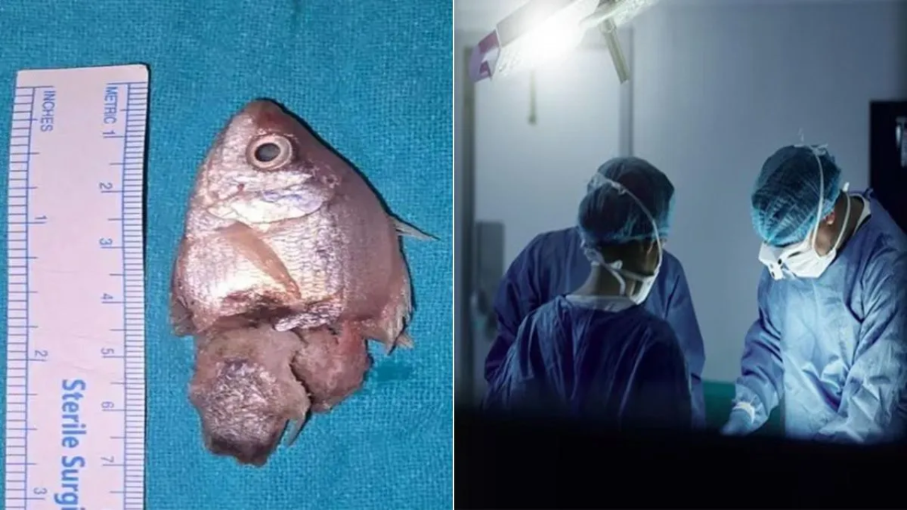 इंदौर में चौंकाने वाला मामला: 1 साल के बच्चे ने निगली जिंदा मछली, डॉक्टरों ने ऑपरेशन कर बचाई जान